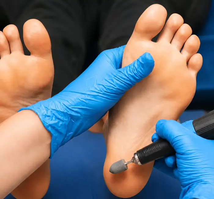 Podiatrist removing corns and callus during treatment at Active Step in Fareham